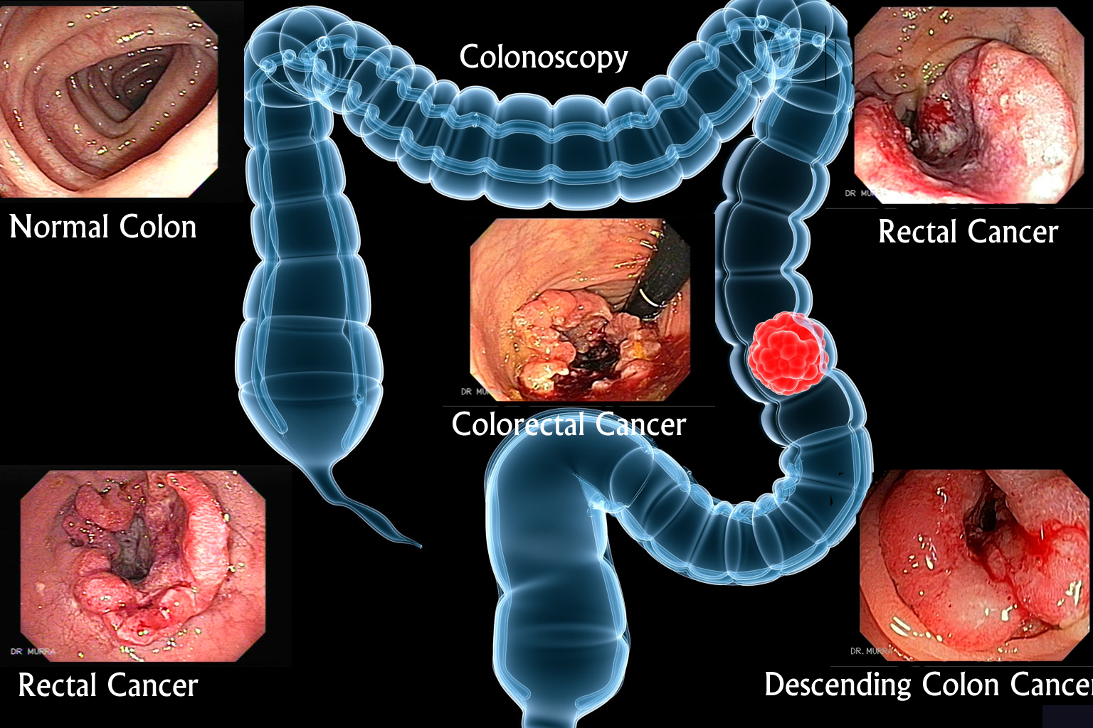 Colo-rectal