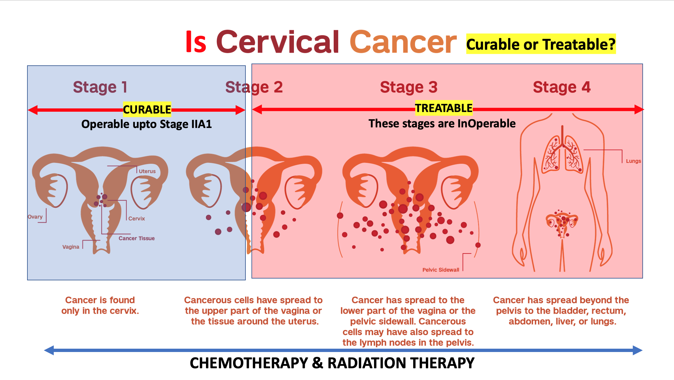 cervical cancer is curable and treatable