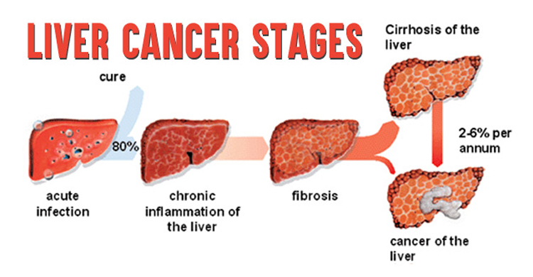 Liver Hepatocellular Cancer Screening