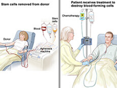 patient receiving stem cell transplant