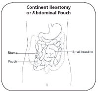Illustration showing a continent ileostomy made by looping part of the ileum back on itself so that a reservoir or pocket is formed inside the belly (abdomen).