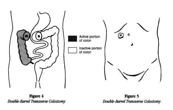 illustration showing a double barrel transverse colostomy from inside the body and from outside including the active and inactive portions of the colon