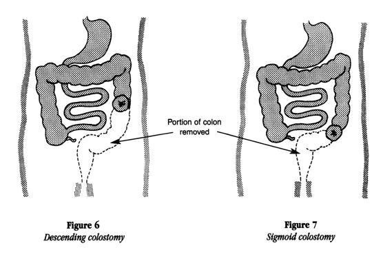 illustration showing the portion of the colon removed for a descending colostomy and a sigmoid colostomy