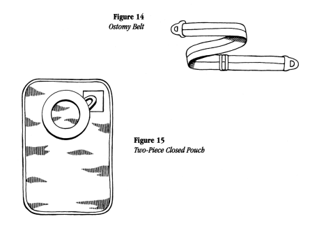 illustration showing an ostomy belt and two-pieced closed pouch