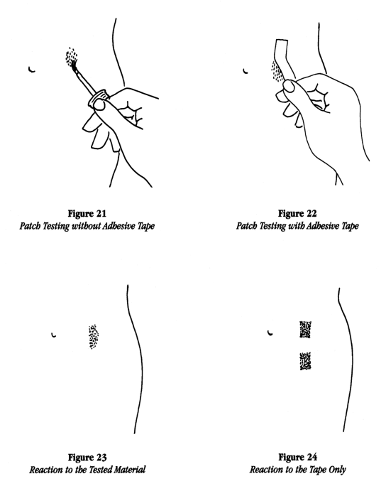 illustration with four figures showing patch testing without adhesive tape, patch testing with adhesive tape, reaction to the tested material and reaction to tape only